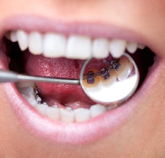 lingual braces shown in a dentist mirror behind teeth