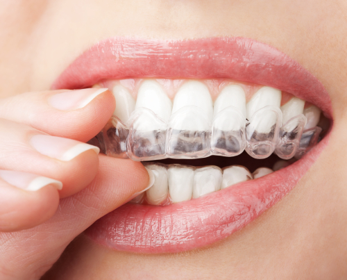 Clear removable aligner being placed on teeth