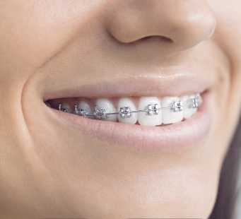 Smiling lady with fixed braces
