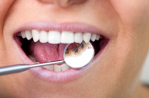 Mirror behind teeth showing attached discreet, lingual braces