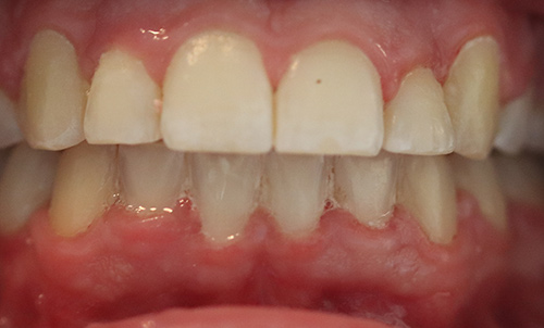 After image following fixed braces at Total Orthodontics