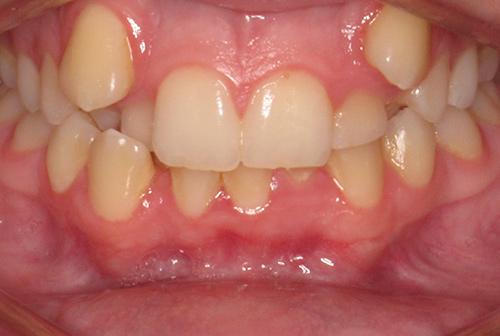 Before image following fixed braces at Total Orthodontics