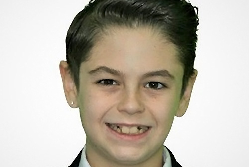 Patient before and after teeth straightening with dental braces