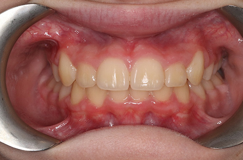 After image following fixed braces at Total Orthodontics