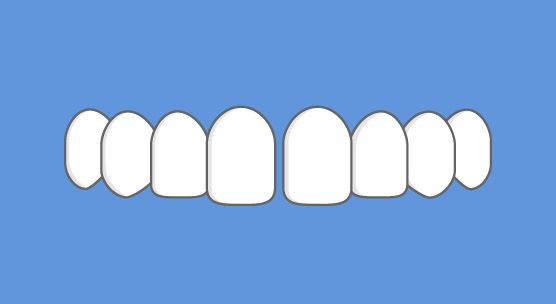 A diagram showing a gap between two teeth