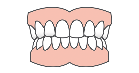 Diagram of teeth with an overbite – where the front teeth overlap the bottom teeth