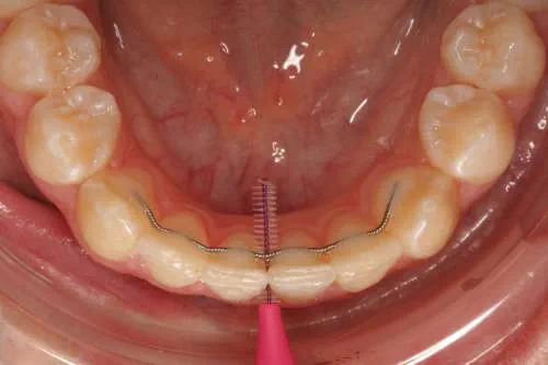 A fixed retainer sits behind the bottom row of teeth, and an interdental brush is being used to clean around retainer and between the teeth