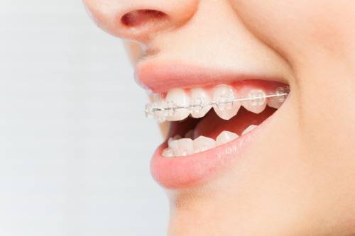 A close up of a woman's smiling mouth seen from the side, with clear fixed braces along the top row of teeth