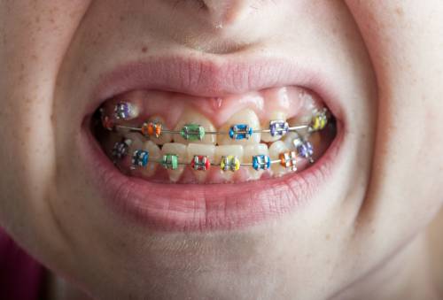 A grimacing mouth with clenched teeth showing colourful fixed braces on the top and bottom rows of teeth