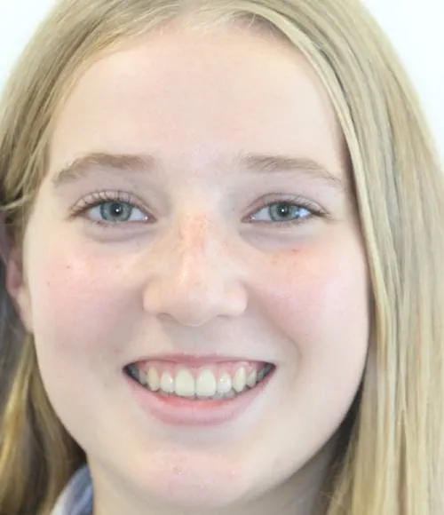 After treatment, the patient's teeth are straight and aligned