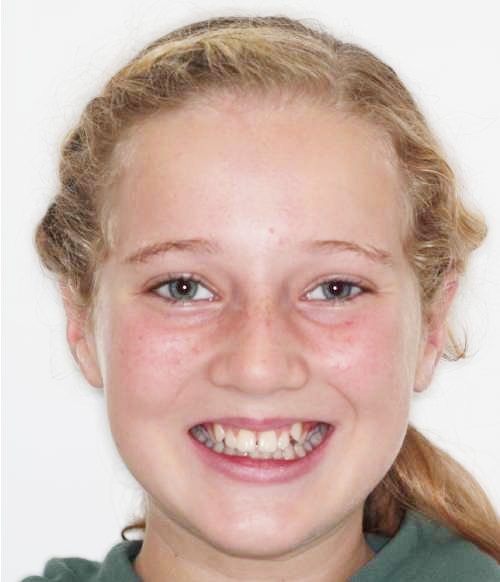 The patient's teeth sit at different heights in the gum and are not aligned