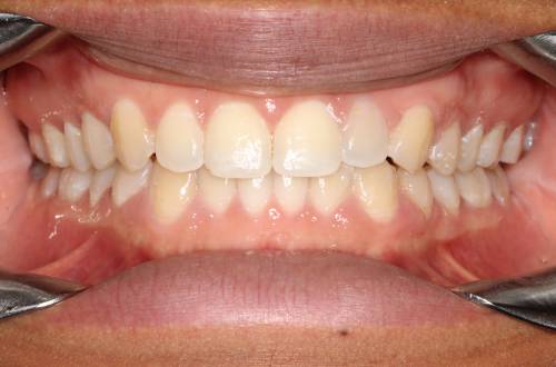  Picture showing top and bottom rows of teeth with teeth aligned and without gaps between the teeth  