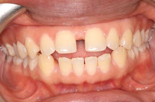  Picture showing top and bottom rows of teeth with gaps and spacing between some of the teeth 