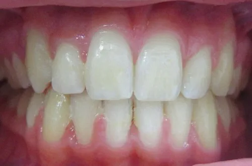 Clean and straight teeth that look perfectly aligned with each other 