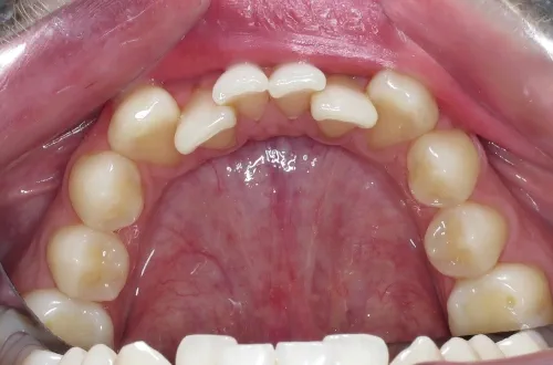 op arch of teeth seen from below showing lateral incisors on both sides sitting behind the position of the rest of the arch of teeth	