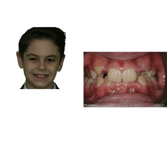 Full face photo showing smiling patient before treatment and inset close up of their teeth