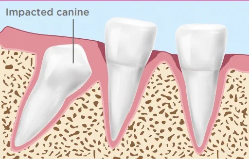 Impacted Canine