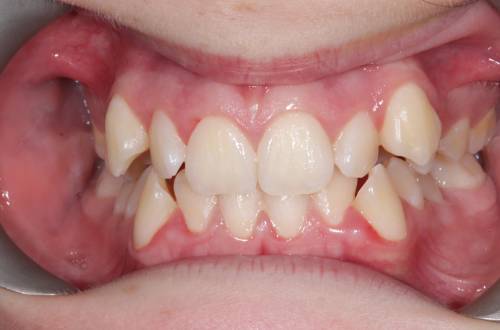 Before teeth straightening, the patient's teeth were misaligned