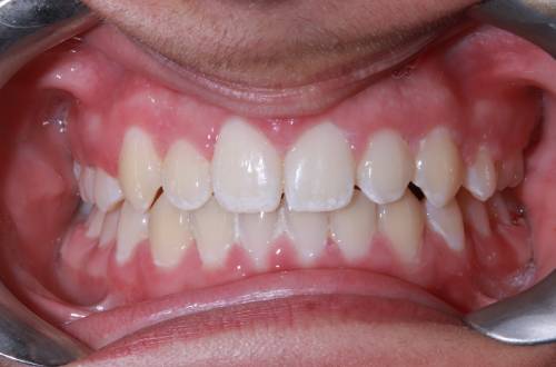 After treatment at Total Orthodontics Uckfield, the patient's teeth are aligned and straight
