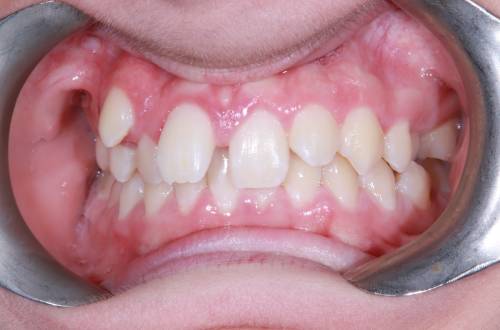 Before treatment, the patient's teeth sit at different levels and angles, with large gaps