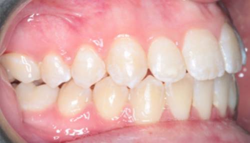After treatment, the patient's teeth are straight and aligned