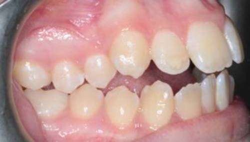 The patient's teeth sit at different heights in the gum and are not aligned