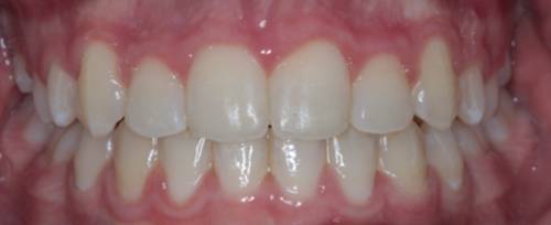 After teeth straightening, the patient's teeth are perfectly aligned