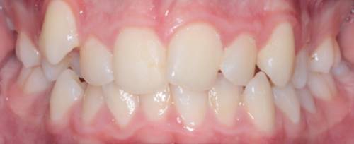 Before treatment, The patient's teeth sit at different heights and don't meet in the bite