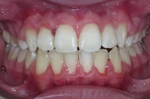 Parted lips showing straight and aligned teeth 