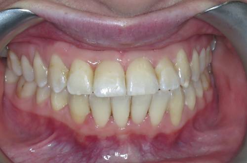 Parted lips showing teeth that site straight and aligned in the patient’s gums 